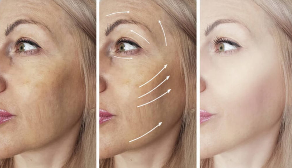 Resultado Harmonização Facial - Antes e Depois